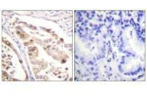Immunohistochemistry analysis of paraffin-embedded human lung carcinoma tissue using RFA2 (Ab-21) antiobdy. (RPA2 Antikörper  (Thr21))