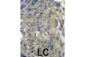 Formalin-fixed and paraffin-embedded human lung carcinoma reacted with FIGF polyclonal antibody  , which was peroxidase-conjugated to the secondary antibody, followed by DAB staining. (VEGFD Antikörper  (C-Term))