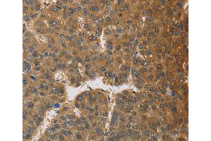 Immunohistochemistry of Human thyroid cancer using TNFRSF10D Polyclonal Antibody at dilution of 1:60 (DcR2 Antikörper)
