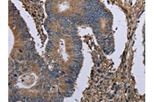 The image on the left is immunohistochemistry of paraffin-embedded Human colon cancer tissue using ABIN7130197(MCM3AP Antibody) at dilution 1/30, on the right is treated with fusion protein. (GANP Antikörper)