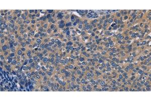 Immunohistochemistry of paraffin-embedded Human cervical cancer using SYT17 Polyclonal Antibody at dilution of 1:60 (SYT17 Antikörper)