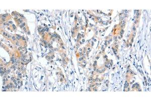 Immunohistochemistry of paraffin-embedded Human colon cancer using Placental Alkaline Phosphatase Polyclonal Antibody at dilution of 1:50 (PLAP Antikörper)