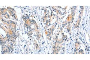 Immunohistochemistry of paraffin-embedded Human colon cancer using Placental Alkaline Phosphatase Polyclonal Antibody at dilution of 1:50