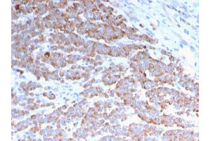 Formalin-fixed, paraffin-embedded human Colon Carcinoma stained with Cytokeratin 18 Mouse Monoclonal Antibody (rKRT18/1190). (Rekombinanter Cytokeratin 18 Antikörper)