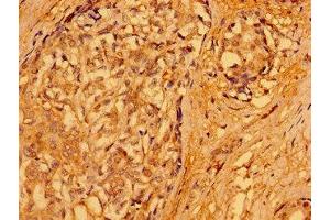 Immunohistochemistry of paraffin-embedded human breast cancer using ABIN7165690 at dilution of 1:100