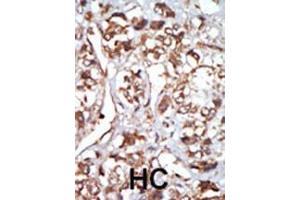 Formalin-fixed and paraffin-embedded human cancer tissue reacted with the primary antibody, which was peroxidase-conjugated to the secondary antibody, followed by AEC staining. (EIF2AK1 Antikörper  (N-Term))