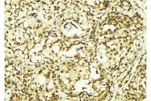 ABIN6269042 at 1/100 staining Human breast cancer tissue by IHC-P. (HSPB6 Antikörper  (N-Term))