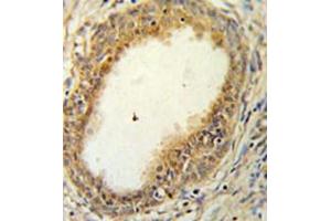 Immunohistochemistry analysis in formalin fixed and paraffin embedded prostate carcinoma reacted with HAPLN1 Antibody (N-term) followed which was peroxidase conjugated to the secondary antibody and followed by DAB staining.