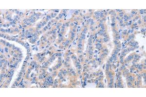 Immunohistochemistry of paraffin-embedded Human thyroid cancer using B3GAT1 Polyclonal Antibody at dilution of 1:40 (CD57 Antikörper)