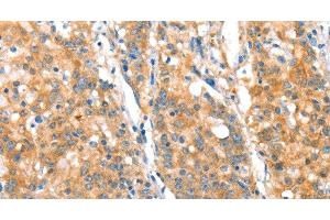 Immunohistochemistry of paraffin-embedded Human gasrtic cancer tissue using ST14 Polyclonal Antibody at dilution 1:70 (ST14 Antikörper)