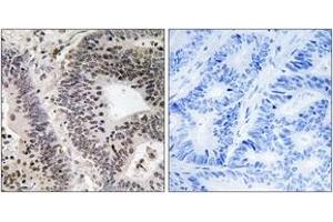 Immunohistochemistry analysis of paraffin-embedded human colon carcinoma, using WWOX (Phospho-Tyr33) Antibody. (WWOX Antikörper  (pTyr33))
