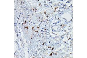 Immunohistochemistry of paraffin-embedded Human pancreatic panniculitis using GSDME Rabbit pAb (ABIN6127757, ABIN6139554, ABIN6139555 and ABIN6223304) at dilution of 1:50 (40x lens). (Non-Syndromic Hearing Impairment Protein 5 (GSDME) (AA 1-260) Antikörper)