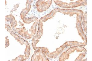 Formalin-fixed, paraffin-embedded human prostate carcinoma stained with Interleukin 10 Recombinant Rabbit Monoclonal Antibody (IL10/2651R). (Rekombinanter IL-10 Antikörper)