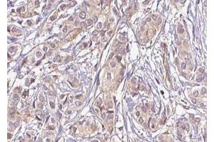 ABIN6269375 at 1/100 staining Human breast cancer tissue by IHC-P.