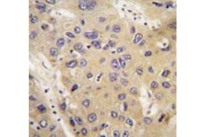 Immunohistochemical staining of formalin-fixed and paraffin-embedded human hepatocarcinoma tissue reacted with ATG12 monoclonal antibody  at 1:50-1:200 dilution. (ATG12 Antikörper)