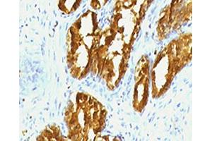 IHC testing of human prostate carcinoma with PSAP antibody (clone PSPN1-1). (Prosaposin Antikörper)