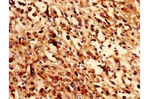 Immunocytochemistry analysis of human melanoma using ABIN7162002 at dilution of 1:100