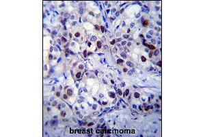 RB1 Antibody  (ABIN1881730 and ABIN2840685) immunohistochemistry analysis in formalin fixed and paraffin embedded human breast carcinoma followed by peroxidase conjugation of the secondary antibody and DAB staining. (Retinoblastoma 1 Antikörper  (AA 586-615))