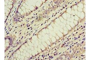 Immunohistochemistry of paraffin-embedded human colon cancer using ABIN7143179 at dilution of 1:100 (ACVR1C/ALK7 Antikörper  (AA 22-113))