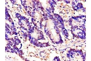 Immunohistochemistry of paraffin-embedded human colon cancer using ABIN7172305 at dilution of 1:100