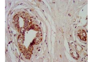 IHC image of ABIN7160564 diluted at 1:400 and staining in paraffin-embedded human breast cancer performed on a Leica BondTM system. (MYH11 Antikörper  (AA 1655-1797))