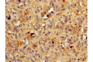 Immunohistochemistry of paraffin-embedded human melanoma using ABIN7145531 at dilution of 1:100 (BACE1 Antikörper  (AA 46-155))