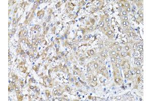 Immunohistochemistry of paraffin-embedded human liver using SNAI1 antibody (ABIN5998900) at dilution of 1/100 (40x lens).