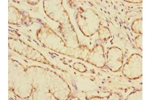 Immunohistochemistry of paraffin-embedded human colon cancer using ABIN7146795 at dilution of 1:100 (CEACAM4 Antikörper  (AA 36-155))