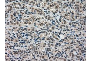 Immunohistochemical staining of paraffin-embedded Adenocarcinoma of breast tissue using anti-LDHA mouse monoclonal antibody.