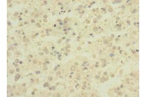Immunohistochemistry of paraffin-embedded human glioma using ABIN7143380 at dilution of 1:100 (ADGRB1 Antikörper  (AA 60-350))