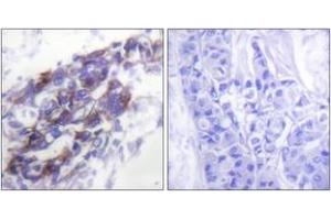 Immunohistochemistry analysis of paraffin-embedded human breast carcinoma tissue, using Keratin 8 Antibody. (KRT8 Antikörper  (AA 434-483))