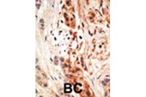Formalin-fixed and paraffin-embedded human cancer tissue reacted with the APOBEC3A polyclonal antibody  , which was peroxidase-conjugated to the secondary antibody, followed by AEC staining. (APOBEC3A Antikörper  (N-Term))