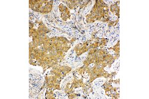 Anti-Hsc70 antibody, IHC(P) IHC(P): Human Lung Cancer Tissue (Hsc70 Antikörper  (C-Term))