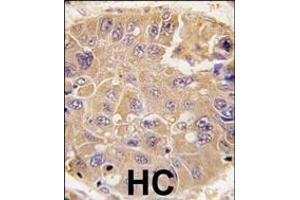 Formalin-fixed and paraffin-embedded human hepatocarcinoma tissue reacted with MET antibody (C-term), which was peroxidase-conjugated to the secondary antibody, followed by DAB staining. (METAP2 Antikörper  (C-Term))