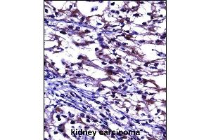 TNFRSF11B Antibody (Center) ((ABIN657660 and ABIN2846654))immunohistochemistry analysis in formalin fixed and paraffin embedded human kidney carcinoma followed by peroxidase conjugation of the secondary antibody and DAB staining.