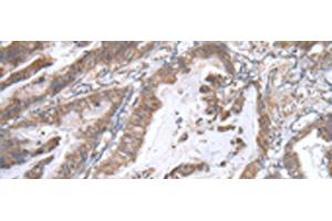 Immunohistochemistry of paraffin-embedded Human esophagus cancer tissue using WWP1 Polyclonal Antibody at dilution of 1:40(x200) (WWP1 Antikörper)