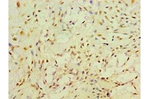 Immunohistochemistry of paraffin-embedded human breast cancer using ABIN7166493 at dilution of 1:100 (Ret Proto-Oncogene Antikörper  (AA 29-300))