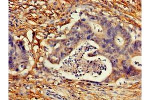 Immunohistochemistry of paraffin-embedded human colon cancer using ABIN7148889 at dilution of 1:100 (CDKN2C Antikörper  (AA 1-68))
