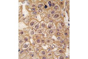 Formalin-fixed and paraffin-embedded human hepatocarcinoma tissue reacted with BAR2 Antibody  (ABIN391397 and ABIN2841401) , which was peroxidase-conjugated to the secondary antibody, followed by DAB staining. (BAR2 Antikörper  (AA 236-264))