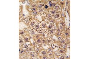 Formalin-fixed and paraffin-embedded human hepatocarcinoma tissue reacted with BAR2 Antibody  (ABIN391397 and ABIN2841401) , which was peroxidase-conjugated to the secondary antibody, followed by DAB staining.