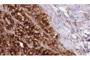 ABIN6272688 at 1/100 staining Human liver cancer tissue by IHC-P. (PTGER1 Antikörper  (Internal Region))