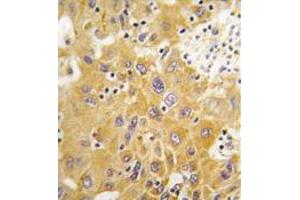Formalin-fixed and paraffin-embedded human hepatocarcinoma tissue reacted with CAMK1-like Antibody (C-term) , which was peroxidase-conjugated to the secondary antibody, followed by DAB staining. (CAMK1D Antikörper  (C-Term))