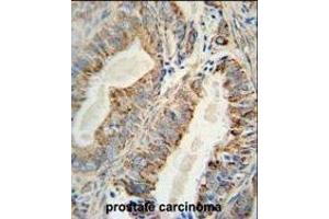 AKT2 Monoclonal Antibody (ABIN659024 and ABIN2838047) immunohistochemistry analysis in formalin fixed and paraffin embedded human prostate carcinoma followed by peroxidase conjμgation of the secondary antibody and DAB staining. (AKT2 Antikörper)