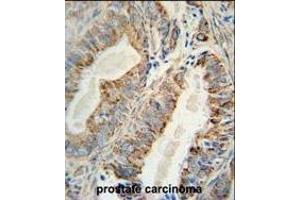 AKT2 Monoclonal Antibody (ABIN659024 and ABIN2838047) immunohistochemistry analysis in formalin fixed and paraffin embedded human prostate carcinoma followed by peroxidase conjμgation of the secondary antibody and DAB staining. (AKT2 Antikörper)
