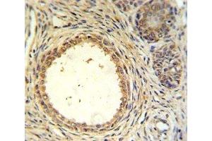 AMH antibody IHC analysis in formalin fixed and paraffin embedded prostate carcinoma. (AMH Antikörper  (AA 424-451))