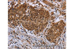 Immunohistochemistry of Human cervical cancer using DUSP8 Polyclonal Antibody at dilution of 1:30 (DUSP8 Antikörper)