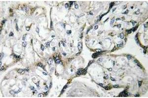 Immunohistochemistry (IHC) analyzes of PAKalpha antibody in paraffin-embedded human breast carcinoma tissue. (PAK1 Antikörper)