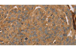 Immunohistochemistry of paraffin-embedded Human breast cancer tissue using PARP11 Polyclonal Antibody at dilution 1:30 (PARP11 Antikörper)