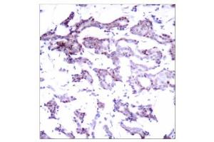 Immunohistochemical analysis of paraffin- embedded human breast carcinoma tissue using Elk-1 (Ab-389) antibody (E021037). (ELK1 Antikörper)