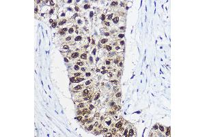 Immunohistochemistry of paraffin-embedded human lung cancer using SM Rabbit pAb (ABIN6132562, ABIN6148098, ABIN6148099 and ABIN6214424) at dilution of 1:100 (40x lens). (SMARCA1 Antikörper  (AA 1-200))
